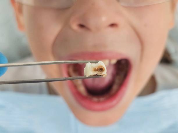 Best Emergency Treatment for Oral Infections in Jefferson City, MO